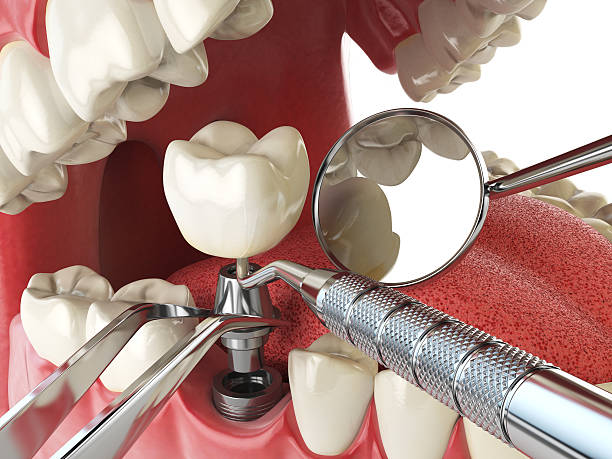 Best Emergency Root Canal Therapy in Bridgeport, NE